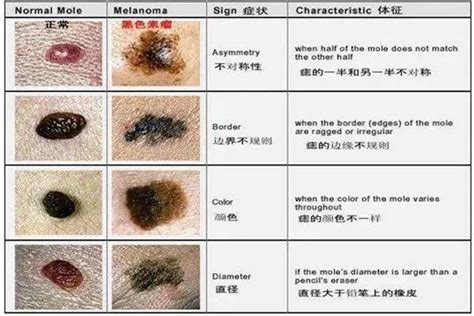 小黑痣|你身上的痣会癌变吗？医生分析了100多颗黑痣，快来。